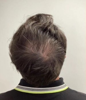 Non-Surgical-Hair-Treatment-Before-4-red51pzv0zu48k4e7cm07xamuxoyszik699bqmpne4