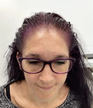 Non-Surgical-Hair-Treatment-Before-5-red51m8i9noyy49utazhxy8she7hy73mtqndtiv830