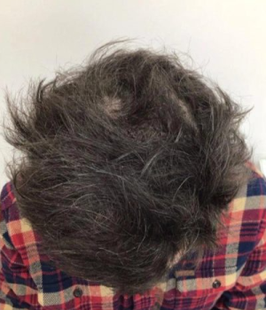 after-non-surgical-hair-treatment-3-red46iqq5z4gujfzed2tyaqszhhcaonbjto38yz3xo